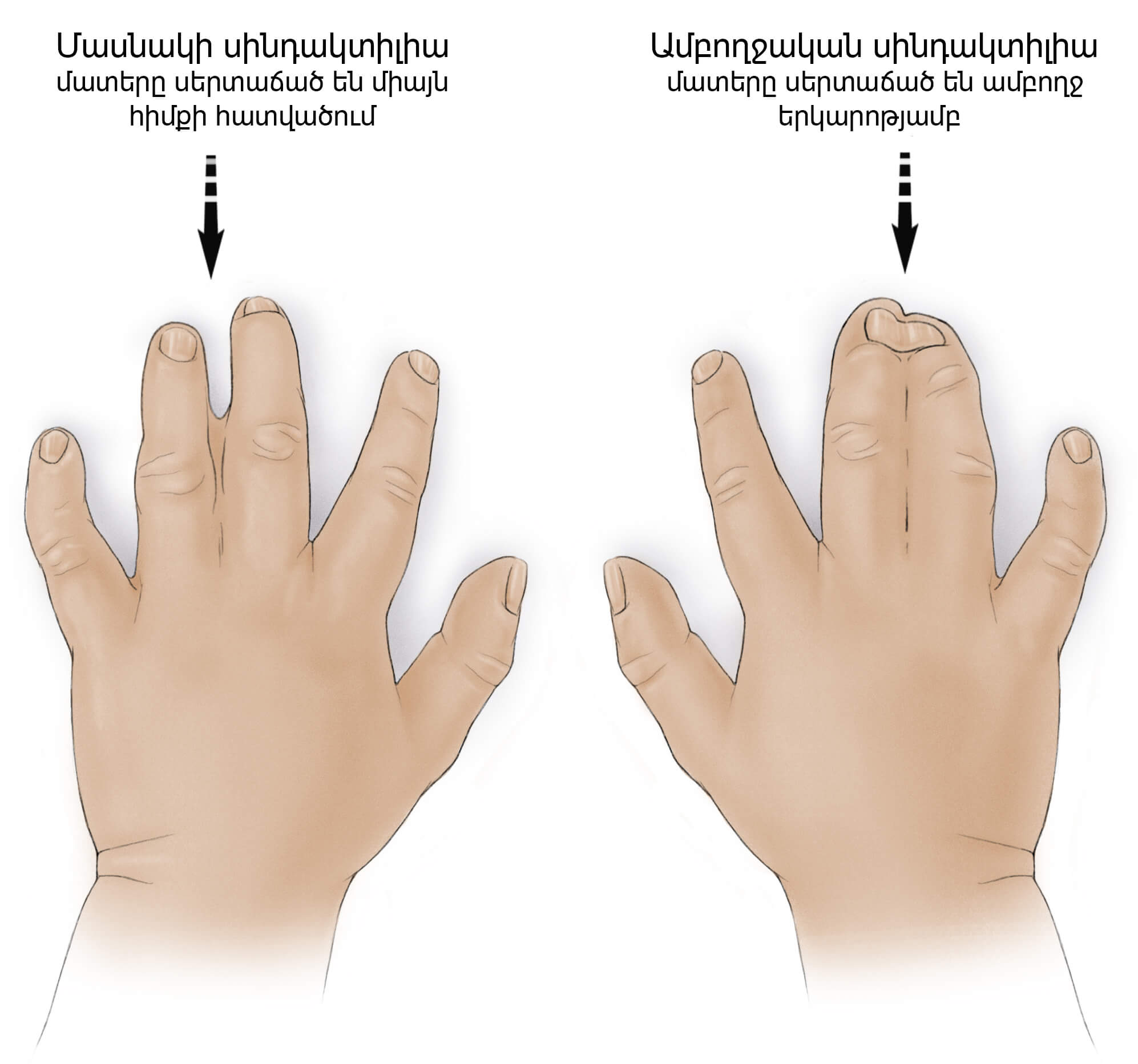 Перепонки между пальцами у мужчин. Синдактилия пальцев рук операция. Синдактилию патология. Аномалии развития пальцев. Два сросшихся пальца на руке.